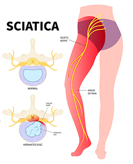sciatica treatments in Fishers