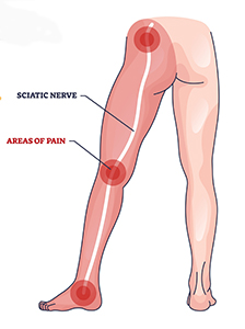 treatments for sciatica in fishers